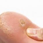 Siğilin Tedavi Yolları