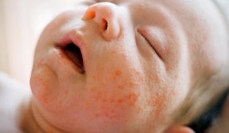 Bebeklerde Egzama Nasıl Geçer