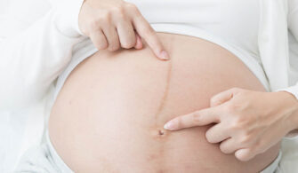 Black line on belly of pregnant women, Pregnancy line or Linea Nigra concept